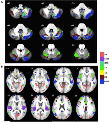 Structural atrophy and functional dysconnectivity patterns in the cerebellum relate to cerebral networks in svMCI